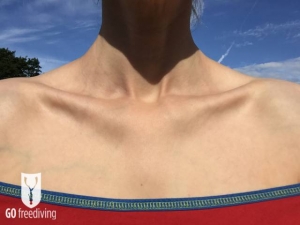 Concave chest after reverse lung packing