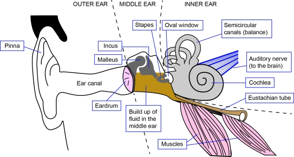 equalisation aid for freedivers glue ear