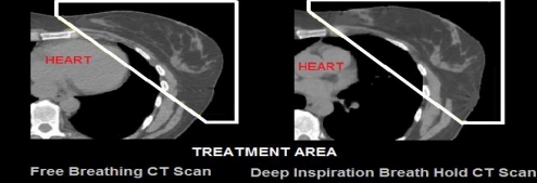 Breast cancer treatment - heart ct scan